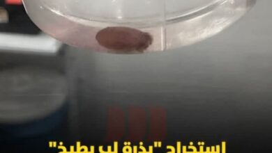 استخراج "بذرة لب بطيخ"من رئة مؤيض بمستشفى الصدر بدمنهور